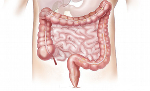 Cancer colon heredite, Cancer colon transverse symptoms