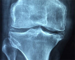 Día Mundial de la Osteoporosis Día Mundial de la Osteoporosis
