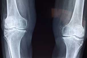 Día Mundial de la Osteoporosis Día Mundial de la Osteoporosis