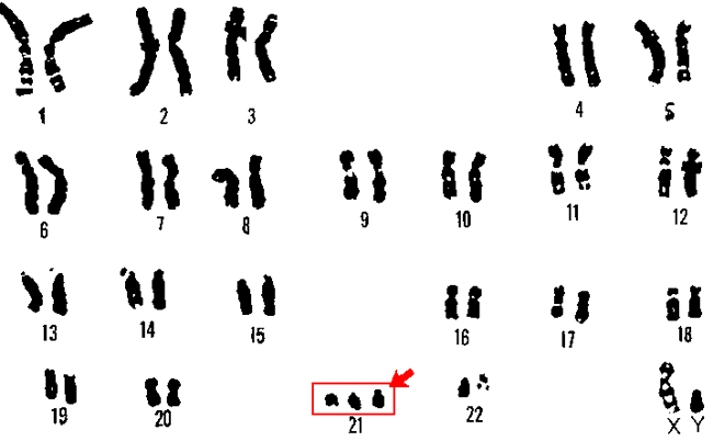 Imagen donde se aprecia la trisomía 21. De U.S. Department of Energy Human Genome Program.